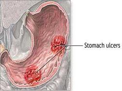 gastric-stomach-ulcers-345200